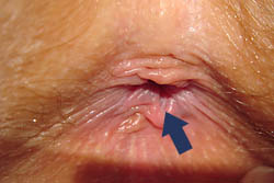 in left pain side vagina lesbian connection personals